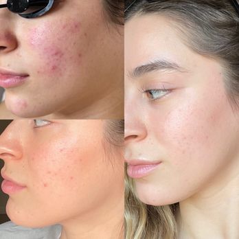 The Skyn Suite - Chemical peel results (7 days) - Sugaring Near Me - Downey, California