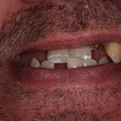 Oren Weiss - Rochester Periodontal & Dental Implants - Teeth in a day before