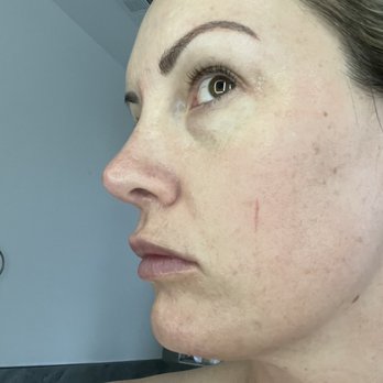 Millennium Day Spa & Salon - European spa facial and lady cut my face!!! - Day Spas Near Me - Scottsdale, Arizona