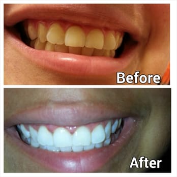 Premier Dental Esthetics | Dentist Arcadia - You can really see the difference! Thanks Rachelle! - Cosmetic Dentists Near Me - Arcadia, California Premier Dental Esthetics | Dentist Arcadia - You can really see the difference! Thanks Rachelle! - Cosmetic Dentists Near Me - Arcadia, California