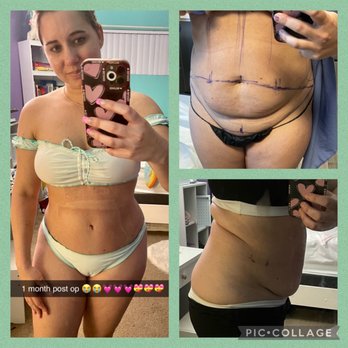 Emil Kohan, MD - 1 month post op an my before photos - Plastic Surgeons Near Me - Beverly Hills, California Emil Kohan, MD - 1 month post op an my before photos - Plastic Surgeons Near Me - Beverly Hills, California