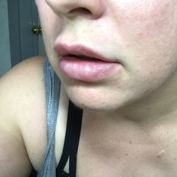 Urban MedSpa - Clusters of blisters - Day Spas Near Me - Chico, California Urban MedSpa - Clusters of blisters - Day Spas Near Me - Chico, California