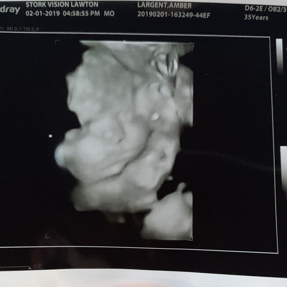 Stork Vision - Stork Vision shot (30 weeks) - Ultrasound Imaging Centers Near Me - Lawton, Oklahoma Stork Vision - Stork Vision shot (30 weeks) - Ultrasound Imaging Centers Near Me - Lawton, Oklahoma