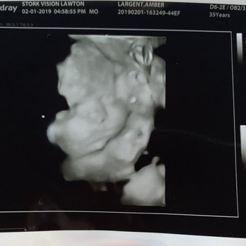Stork Vision - Stork Vision shot (30 weeks) - Ultrasound Imaging Centers Near Me - Lawton, Oklahoma Stork Vision - Stork Vision shot (30 weeks) - Ultrasound Imaging Centers Near Me - Lawton, Oklahoma