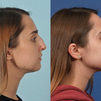 Jesse E Smith, MD, FACS - Rhinoplasty Before & After #14 - Plastic Surgeons Near Me - Fort Worth, Texas Jesse E Smith, MD, FACS - Rhinoplasty Before & After #14 - Plastic Surgeons Near Me - Fort Worth, Texas