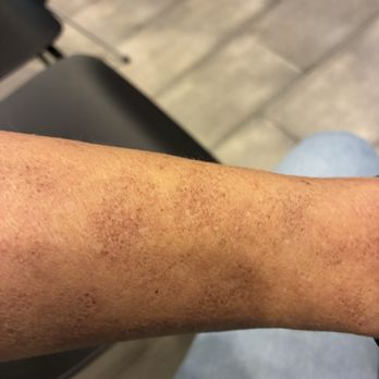 TruDerm - Almost two weeks after reviving a photo laser with no pain gel or ultrasound lotion - Dermatologists Near Me - Wellington, Florida TruDerm - Almost two weeks after reviving a photo laser with no pain gel or ultrasound lotion - Dermatologists Near Me - Wellington, Florida