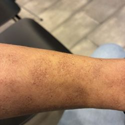 TruDerm - Almost two weeks after reviving a photo laser with no pain gel or ultrasound lotion