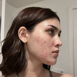 David Robles, MD, PhD Oak Tree Dermatology - Before