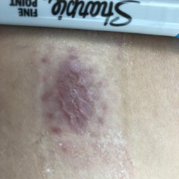 Scar from mole removal. Notice the 12 scars from the stitches? 7/20/19