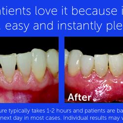 Moorpark Smiles Dental - Rejuvenate your appearance without sutures, or grafting! See our website under Pinhole Surgical Technique!