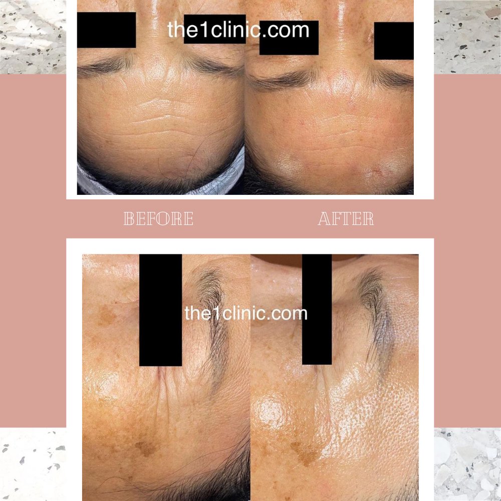 THE ONE ACUPUNCTURE, AESTHETICS & TEA BAR Updated August 2024 10