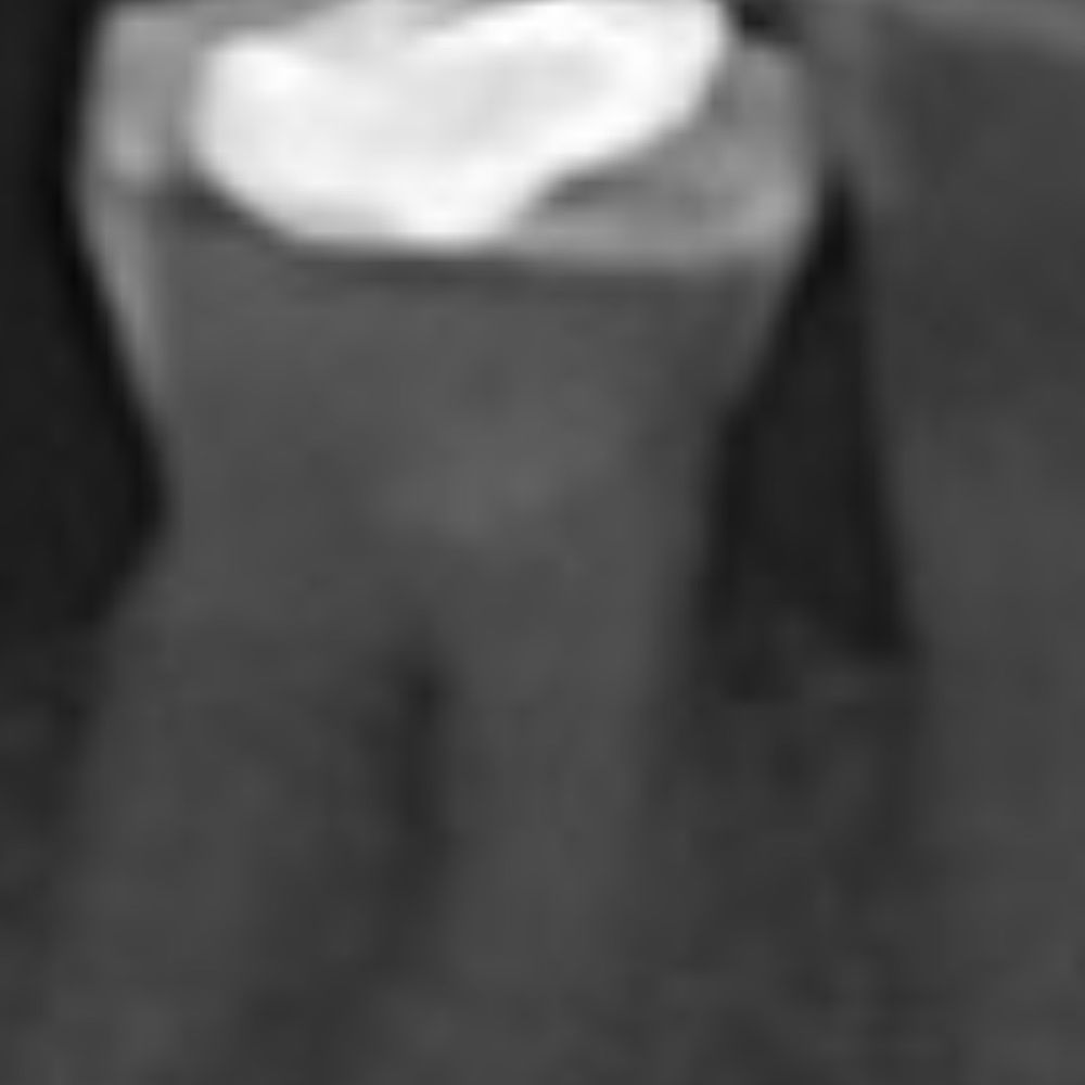 Artistic Smiles Dentistry - Amalgam filling  that was hurting needs extraction only - General Dentistry Near Me - Orange, California