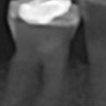 Artistic Smiles Dentistry - Amalgam filling that was hurting needs extraction only - General Dentistry Near Me - Orange, California Artistic Smiles Dentistry - Amalgam filling that was hurting needs extraction only - General Dentistry Near Me - Orange, California