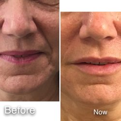 Healthy Way Medical Center - Botox, Dysport, Xeomin Injection, Juvederm, Rstylane, Kybella, for nasolabial folds, chin and lip enhancement, for fine line reduction