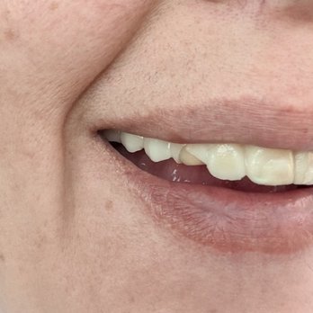 CG Smile - Temporaries after one week , but this was broken after one day - Cosmetic Dentists Near Me - Miami, Florida