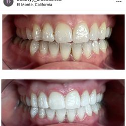 Beauty Unleashed - Teeth whitening. This smile was brightened with just a 60 min session