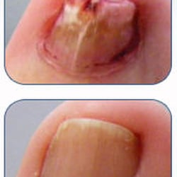 Dale Monast, DPM - Largo Foot & Ankle Center - Before and After Laser Solution