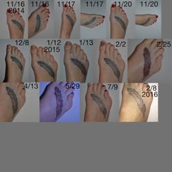 Project Erase Tattoo Removal - Foot tattoo ~8 sessions (tattoo removal progress from 11/2014-2/2016)