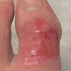 Sandy Nails - 2ND DEGREE BURNS FROM SANDY NAILS!!