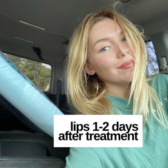 Daphne de Beaute - My lips 1-2 days after treatment - Eyelash Service Near Me - San Jose, California Daphne de Beaute - My lips 1-2 days after treatment - Eyelash Service Near Me - San Jose, California