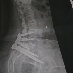 Gulf Orthopaedics | Hillcrest - Spinal fusion