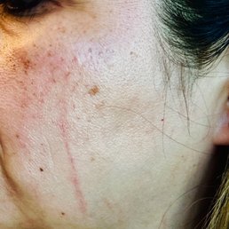 This is the evening after my dermaplaning treatment, my skin was left with a deep scratch and inflamed. This is the evening after my dermaplaning treatment, my skin was left with a deep scratch and inflamed.