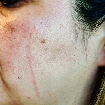 Faces365 - This is the evening after my dermaplaning treatment, my skin was left with a deep scratch and inflamed. - Skin Care Near Me - Roseville, California Faces365 - This is the evening after my dermaplaning treatment, my skin was left with a deep scratch and inflamed. - Skin Care Near Me - Roseville, California