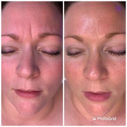 Before and immediately after one Hydrafacial treatment.