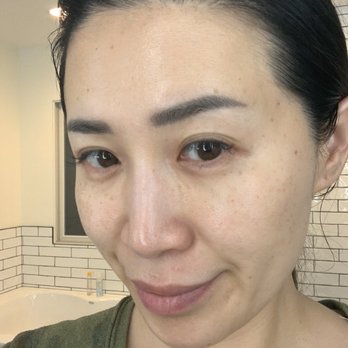 Radiance Med Spa - Before IPL and picosure - Medical Spas Near Me - Pasadena, California Radiance Med Spa - Before IPL and picosure - Medical Spas Near Me - Pasadena, California