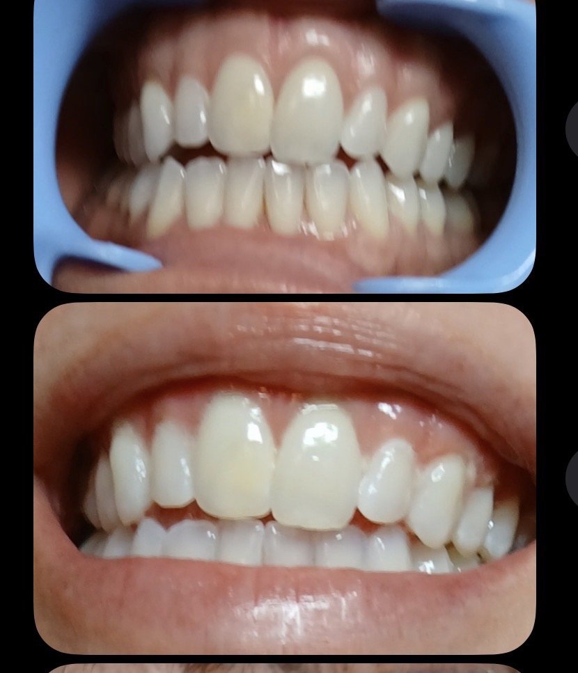 Bite Professional Teeth Whitening Logo