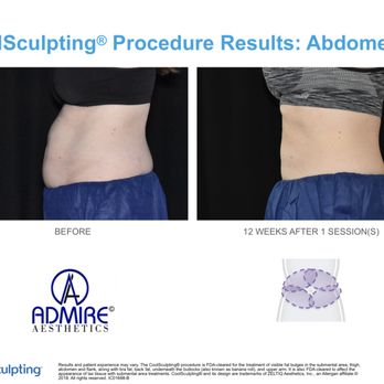 Admire Aesthetics - Coolsculpting Abdomen - Body Contouring Near Me - Grants Pass, Oregon