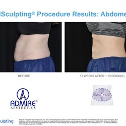 Admire Aesthetics - Coolsculpting Abdomen