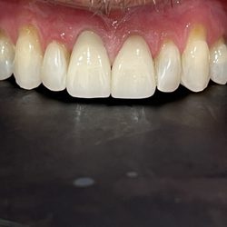 Elite Care Dental - Pt just for his front teeth fixed after A car accident