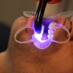 Brian Hale Dentistry - In-Office whitening