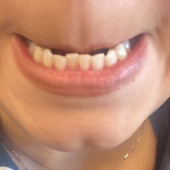 Arizona Orthodontic Studio - before - Orthodontists Near Me - Phoenix, Arizona