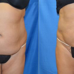 Silhouette Body Sculpting - Upper and lower abdominal fat removal with full, natural skin retraction