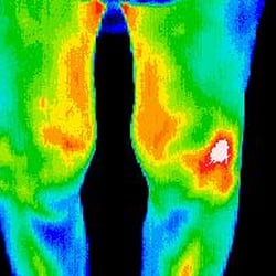 Thermal Body Scan Santa Cruz - Arthritis.  Thermography can detect disease and dysfuncion anywhere in the body.
