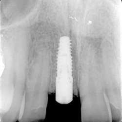 Dental Implant placement