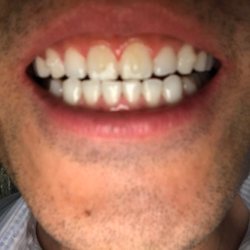 Santa Ana Orthodontics - Half way through my Invaslign treatment, and my teeth are almost perfectly straight. Dr. Luong and her team are the best!