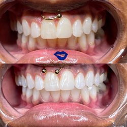 She's Rare Beauty Bar - Teeth whitening