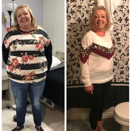 Day of surgery and 9 months out! Day of surgery and 9 months out!