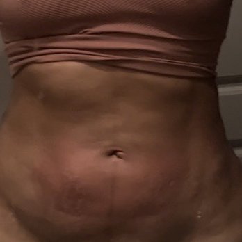 Victoria Heavenly Spa - Hard lumps on abdomen and bloating - Skin Care Near Me - Houston, Texas Victoria Heavenly Spa - Hard lumps on abdomen and bloating - Skin Care Near Me - Houston, Texas