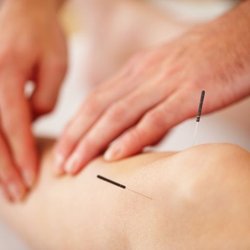 ACA Acupuncture & Wellness - Washington Heights - Acupuncture