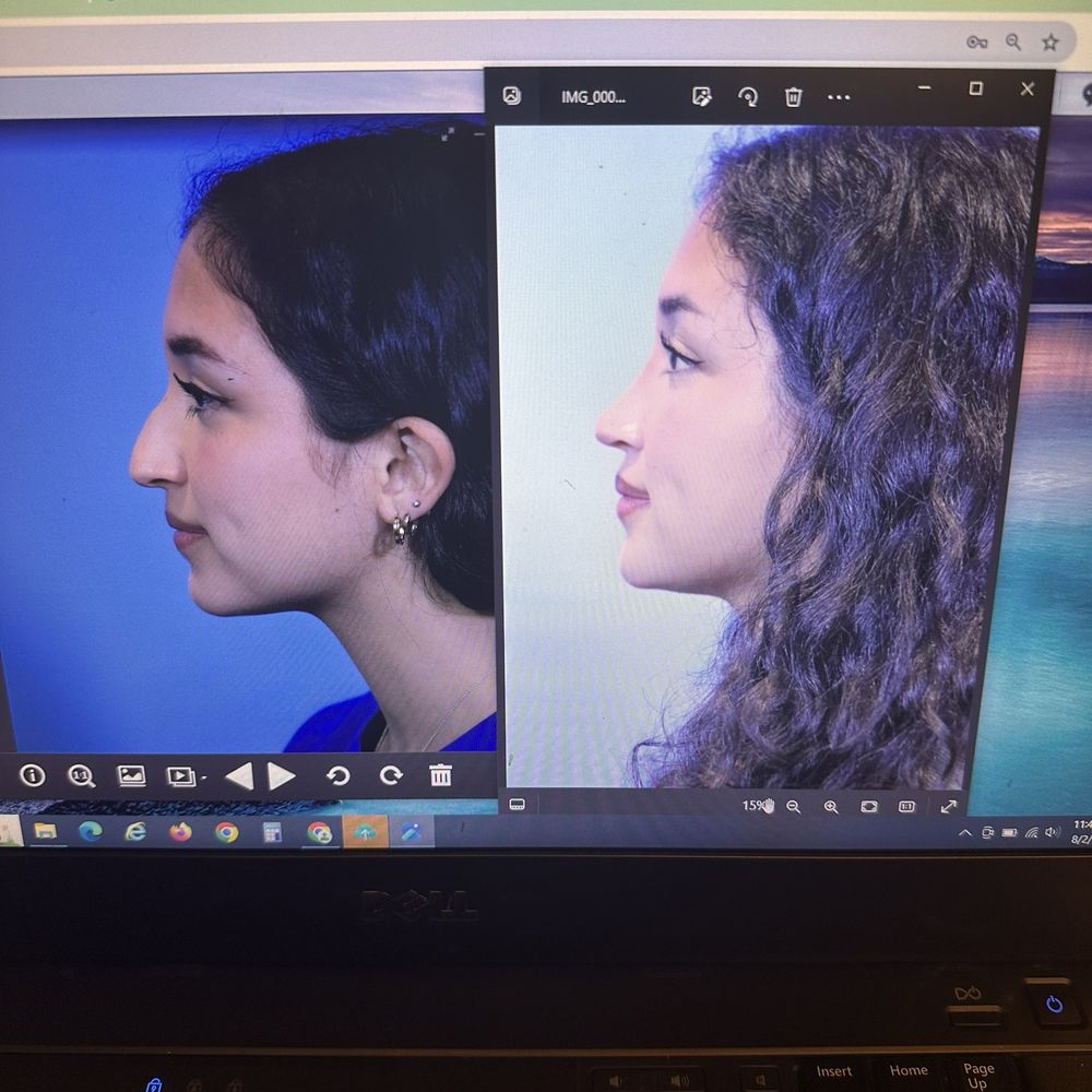 Jose Barrera, MD - side by side before (april 2023) and after 1 year (august 2024) - Cosmetic Surgeons Near Me - San Antonio, Texas