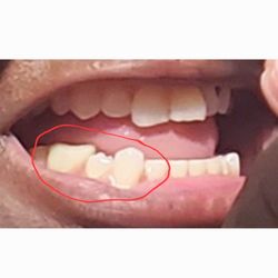 A Harvey Leslie, DMD - Cleveland Dental Clinic - Aweful! BOTCHED! The teeth in the front are too short and the molar is double the size of my teeth. Feels like rough plastic!!!!
