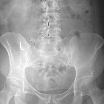 Care More Chiropractic - My back before getting treated. No wonder I was in pain. - Chiropractors Near Me - Roswell, Georgia