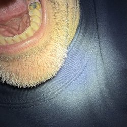 Exceptional Dentistry of Shepherdsville - My mouth where their horrible product failed after 3 1/2 years and refused to fix.