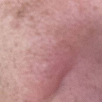 dan modern chinese - More welts on other side of face - Chinese Near Me - Long Beach, California