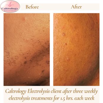 Caltrology Electrolysis - Before & After pictures of Caltrology Electrolysis client - Hair Removal Near Me - Solana Beach, California