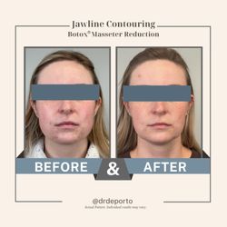 Liquid Beauty - Temecula masseter Botox by Dr. DePorto, contoured jawline.